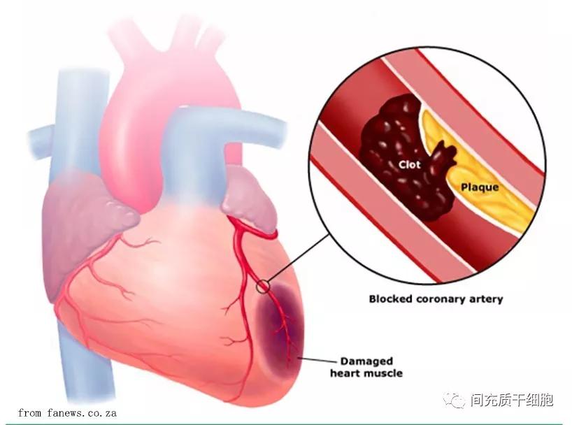 心梗最新研究与进展概述