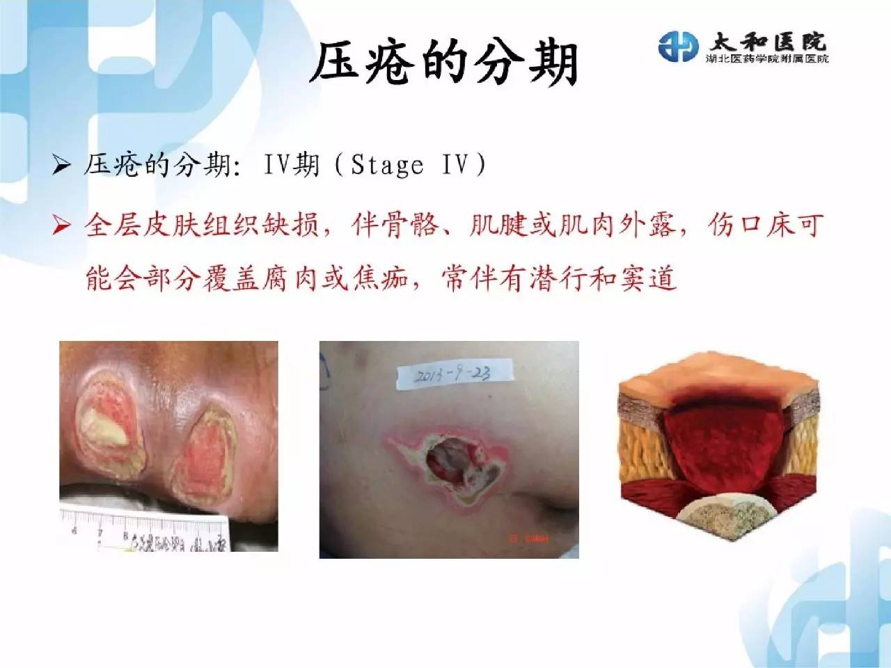 压疮最新研究成果与防治策略探讨